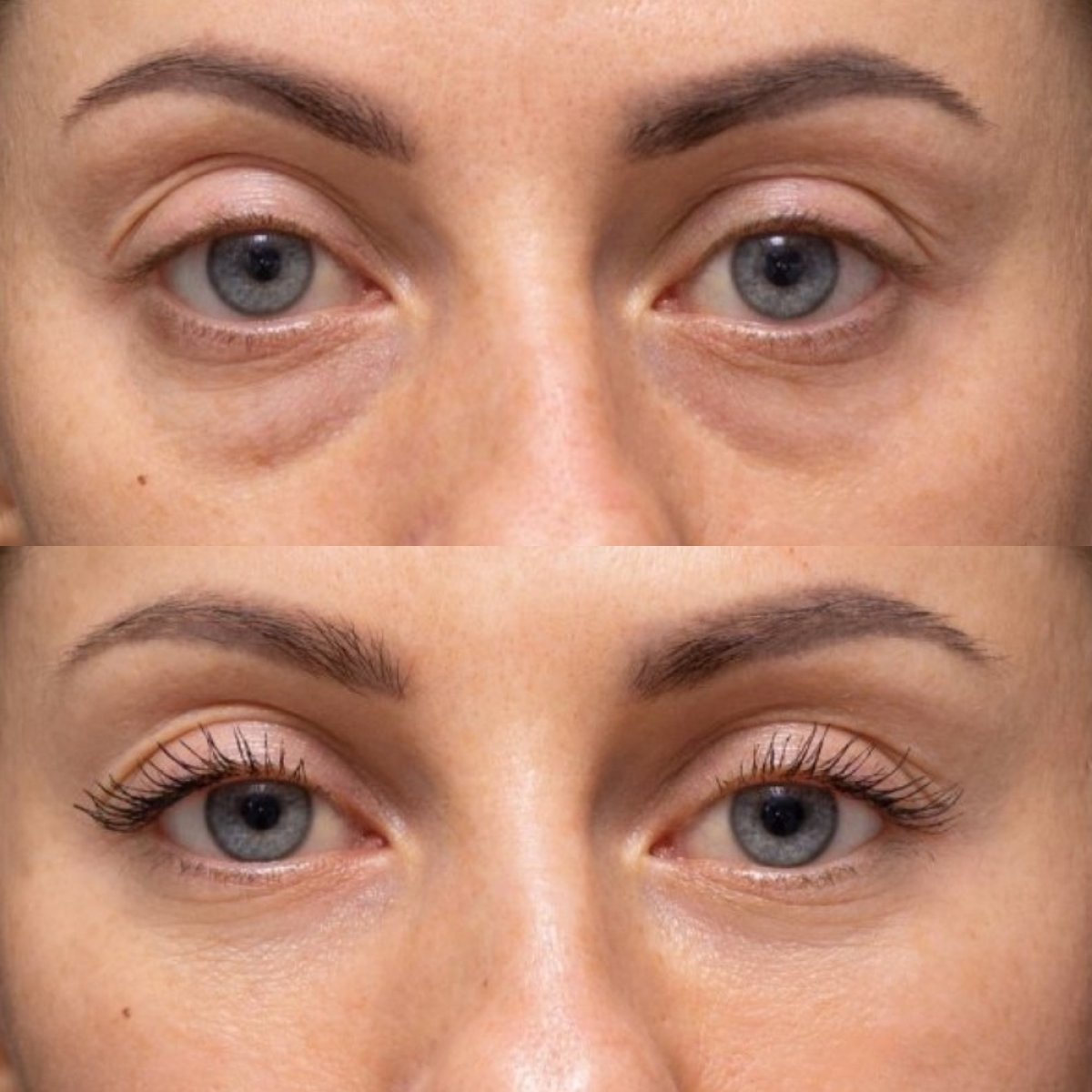 Résultats de blépharoplastie des paupières inférieures avant/après à la Vidnova Clinic