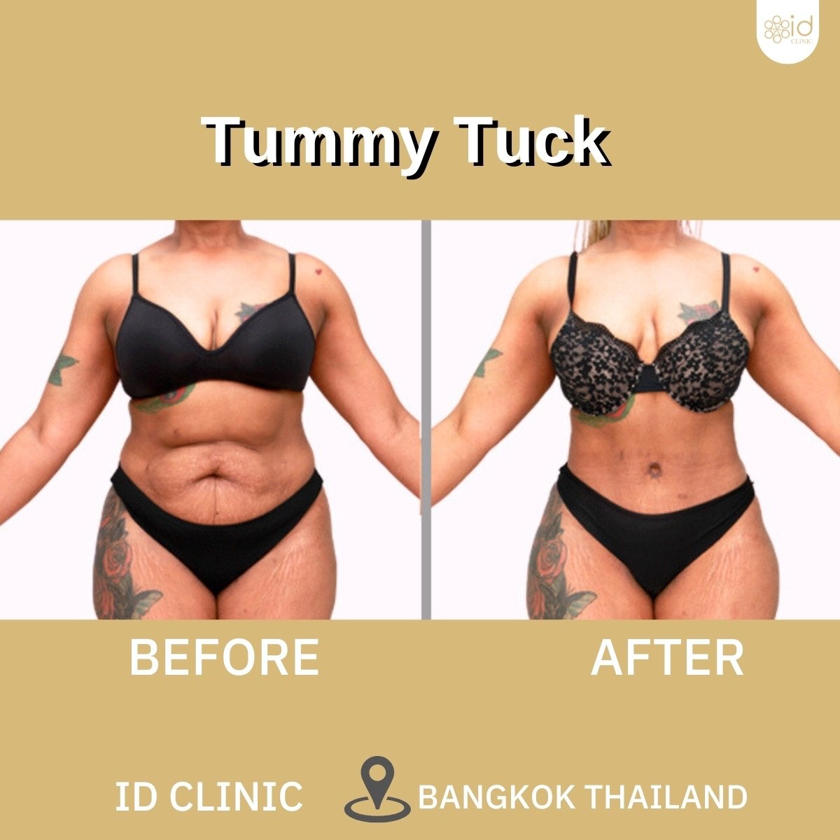 نتائج شد البطن قبل وبعد في ID Clinic Bangkok – تحسين واضح لشكل البطن