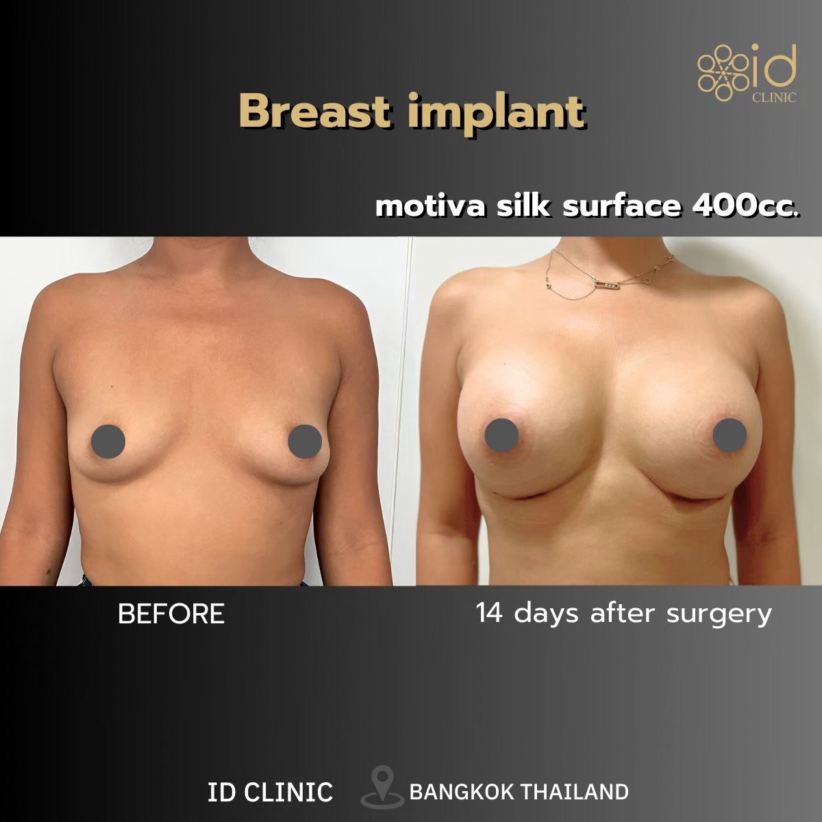 نتائج تكبير الثدي بحشوات Motiva في ID Clinic Bangkok بعد 14 يومًا