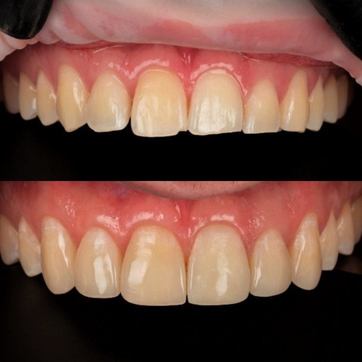 Resultados antes y después de relleno estético en RIKOTA Dental Clinic, sonrisa mejorada