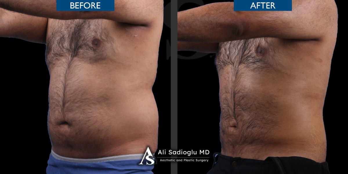 Résultats avant/après chirurgie gynécomastie à la clinique Dr. Safa Manav, torse plat