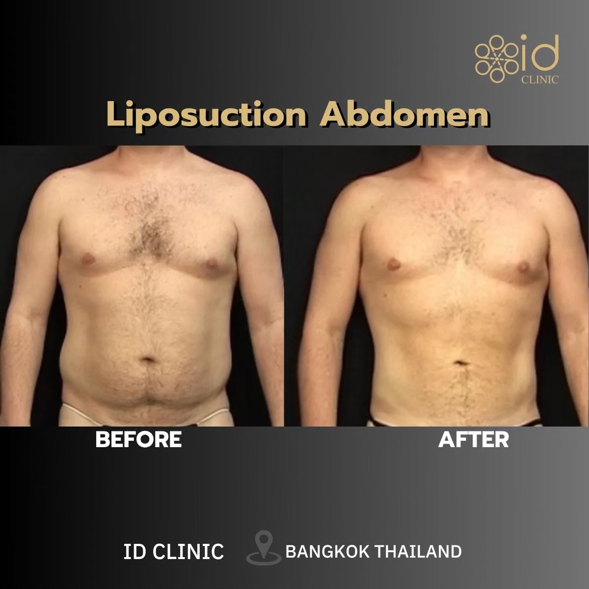 Before and after Vaser liposuction abdomen results at ID Clinic Bangkok, visible contouring