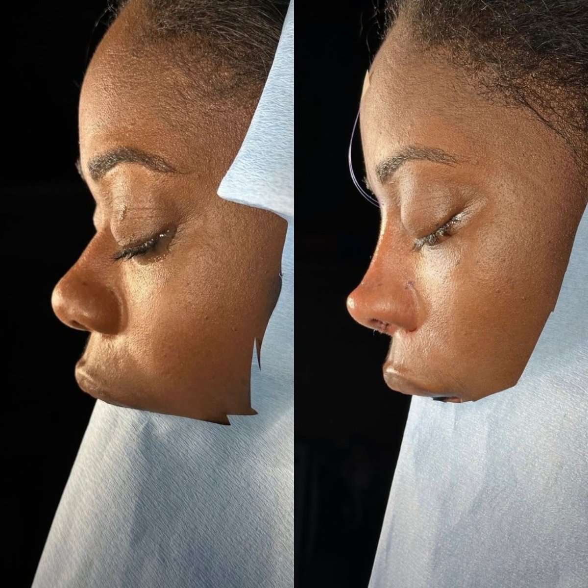 Resultados de rinoplastia antes y después en Lokman Hekim Istanbul Hospital, remodelación nasal