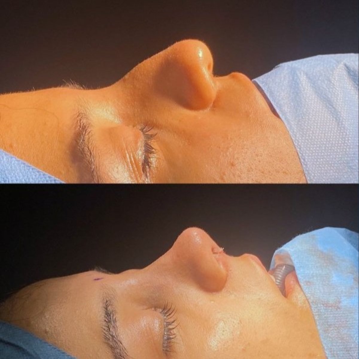 نتائج تجميل الأنف قبل وبعد في مستشفى لوكمان حكيم إسطنبول، تحسين شكل الأنف