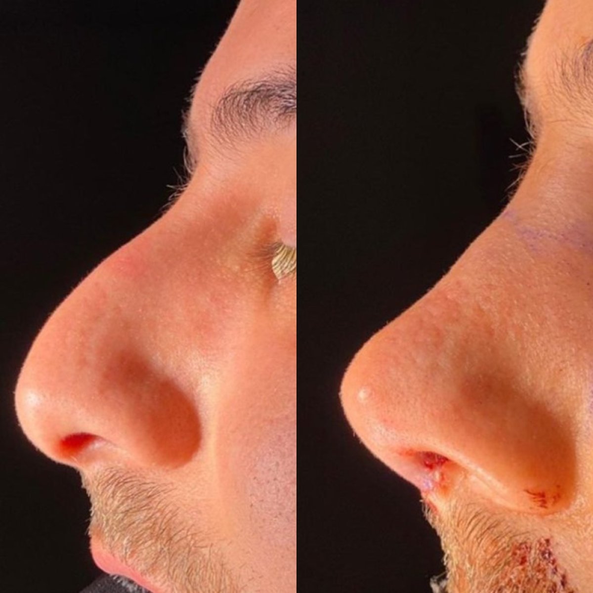 نتائج تجميل الأنف قبل وبعد في مستشفى لوكمان حكيم إسطنبول، إعادة تشكيل الأنف
