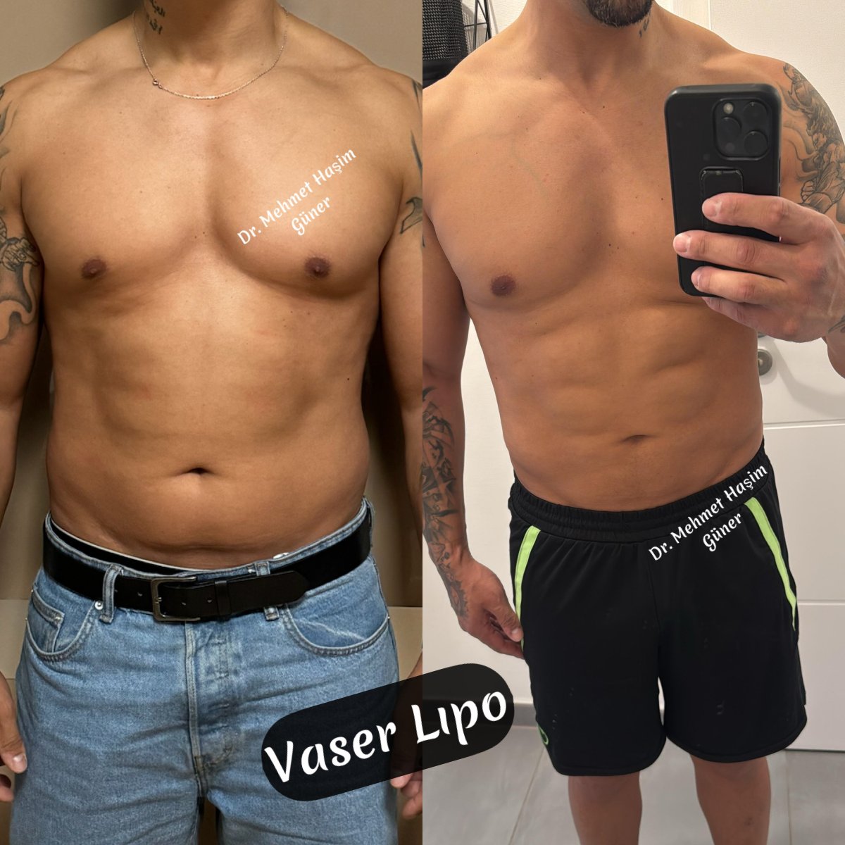 Vorher-nachher-Ergebnis Vaser-Liposuktion bei Dr. Mehmet Haşim Güner, definierte Bauchmuskeln