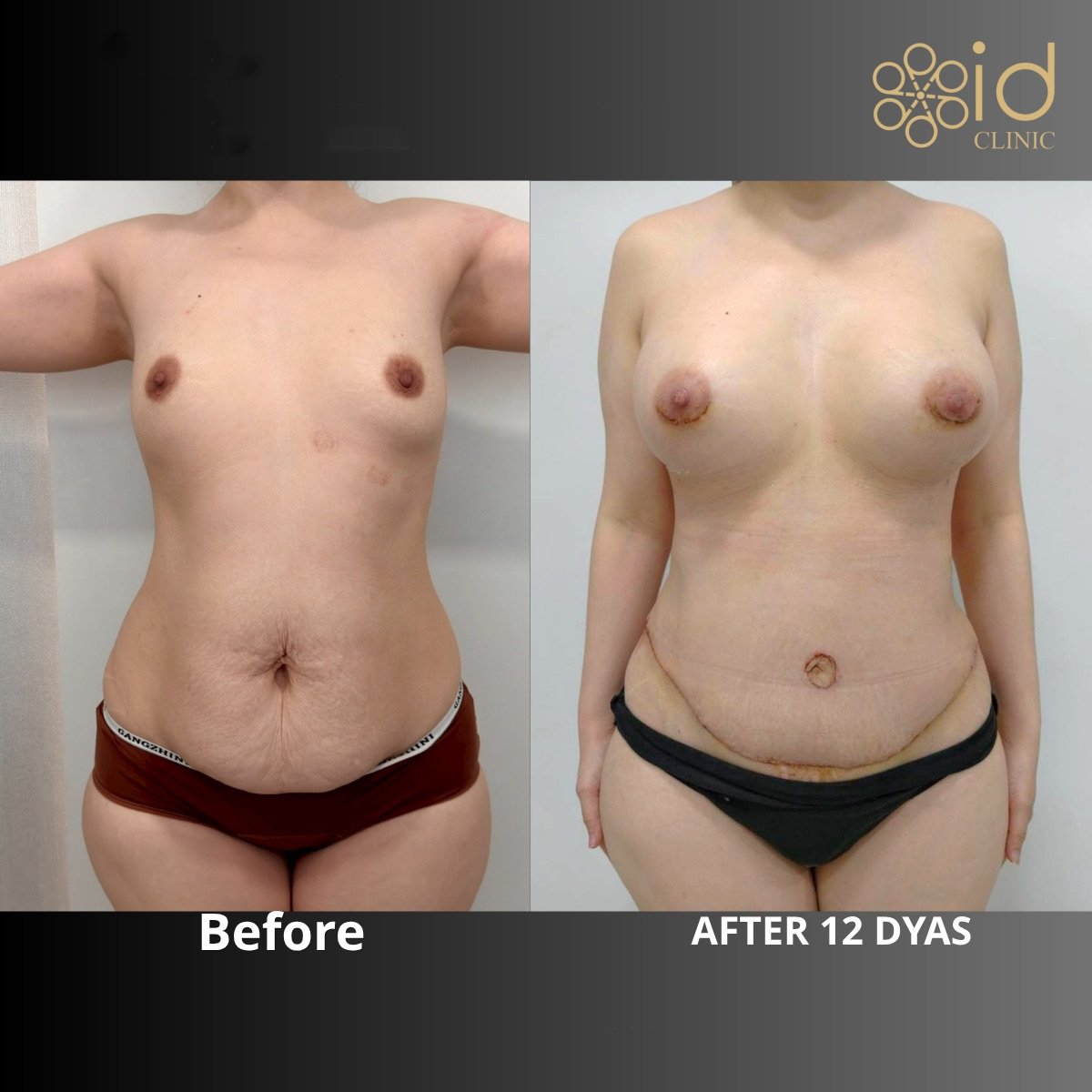 نتائج قبل وبعد عملية تجميل الأم في ID Clinic Bangkok – تحسين الجسم والثدي