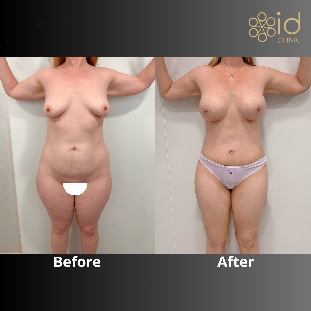 نتائج قبل وبعد عملية تجميل الأم في ID Clinic Bangkok – تحسين شكل الجسم