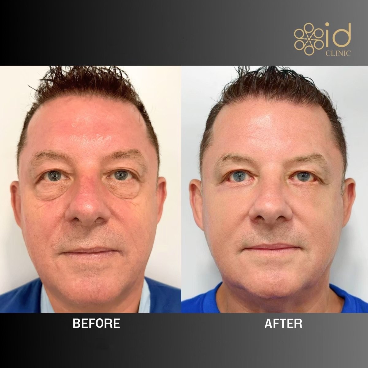 Resultados de blefaroplastia de párpado inferior antes y después en ID Clinic Bangkok