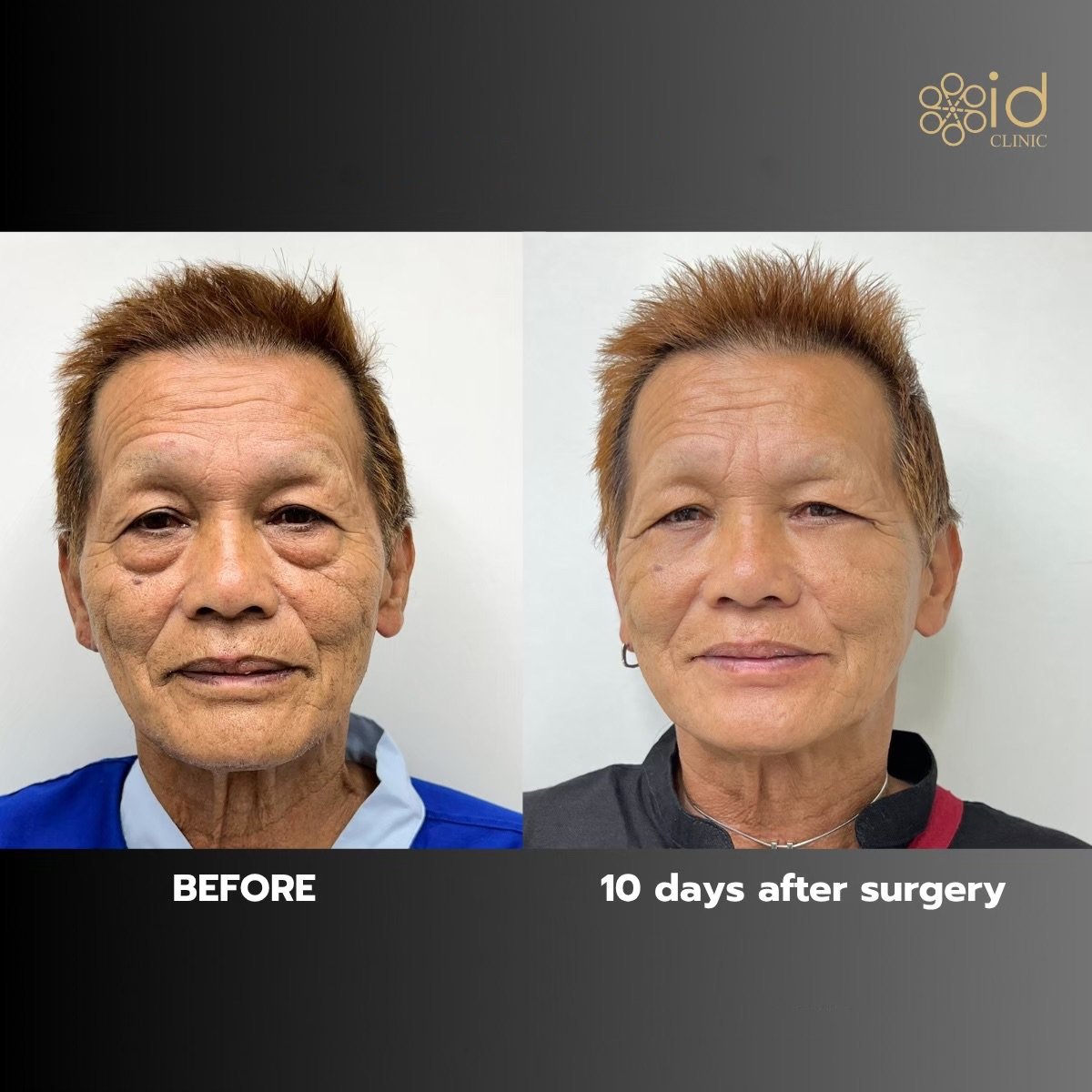Résultats blépharoplastie paupière inférieure avant/après à ID Clinic Bangkok, 10 jours post-op