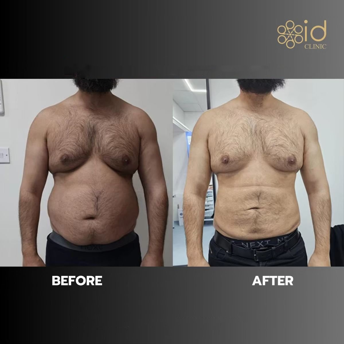 Resultados de liposucción antes y después en ID Clinic Bangkok con mejor contorno abdominal