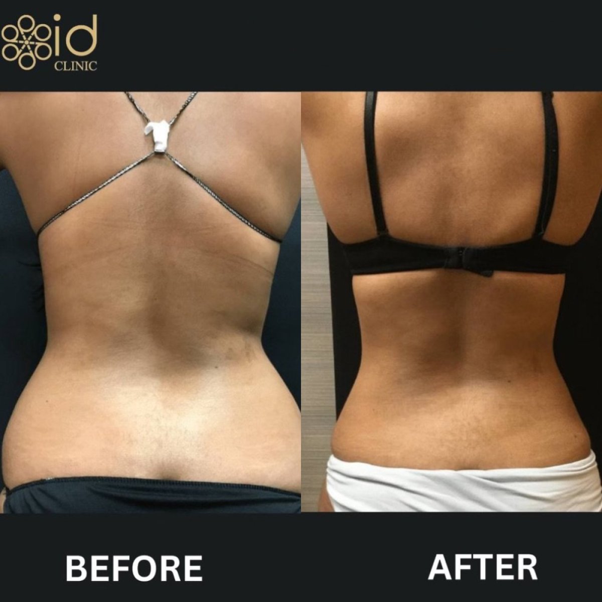 نتائج شفط الدهون قبل وبعد في ID Clinic Bangkok مع تحسين واضح لمحيط الخصر