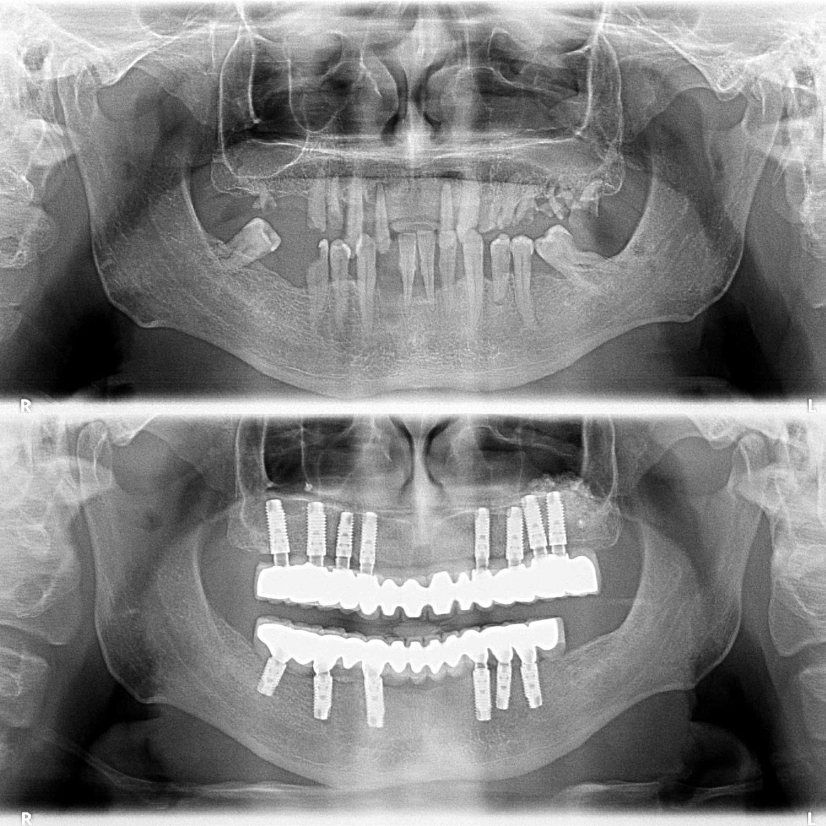 Before and after dental implant results at Ader Dent Oral and Dental Health Polyclinic, full mouth restoration