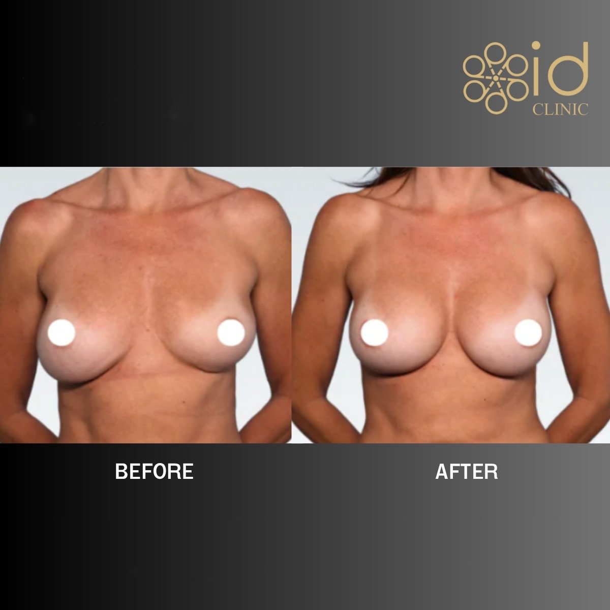 Antes y después de elevación de senos con implantes redondos en ID Clinic Bangkok, resultado mejorado