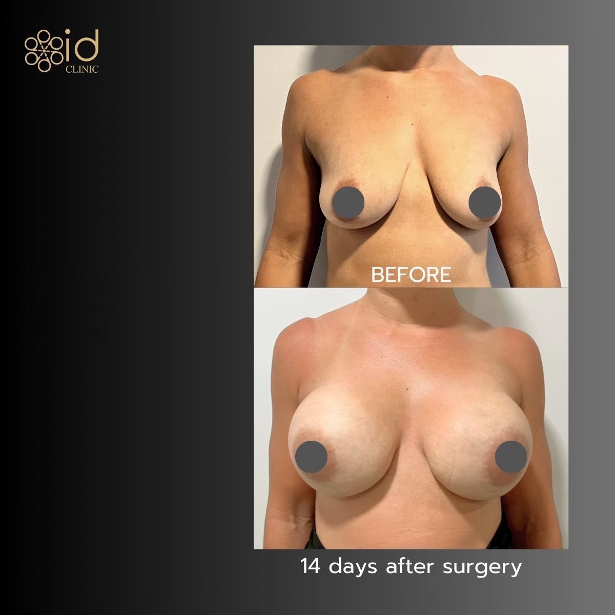 Antes y después de mastopexia con implantes redondos en ID Clinic Bangkok, resultado a 14 días