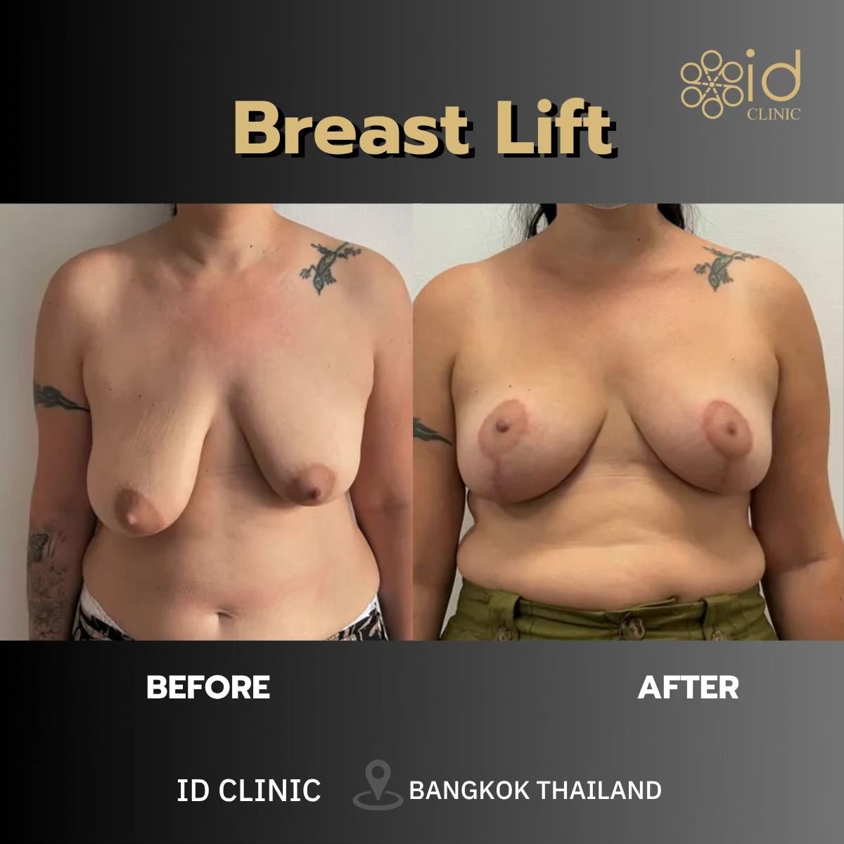 Before and after breast lift results at ID Clinic Bangkok – visible breast contour improvement