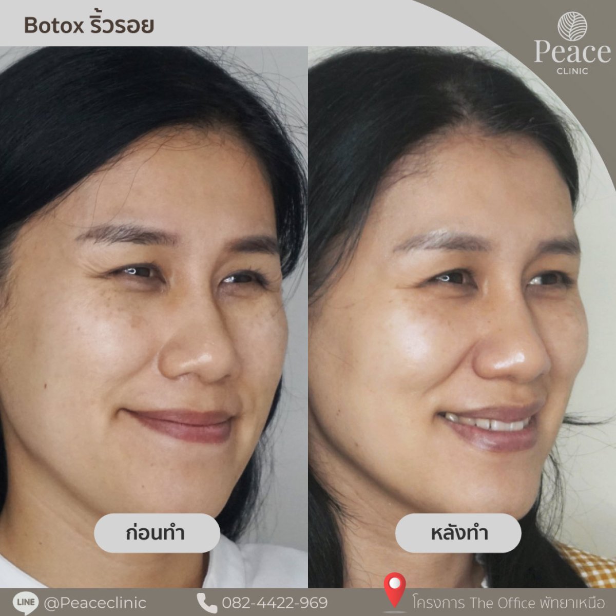 Before and after Botox wrinkle treatment results at Peace Clinic, smoother facial skin