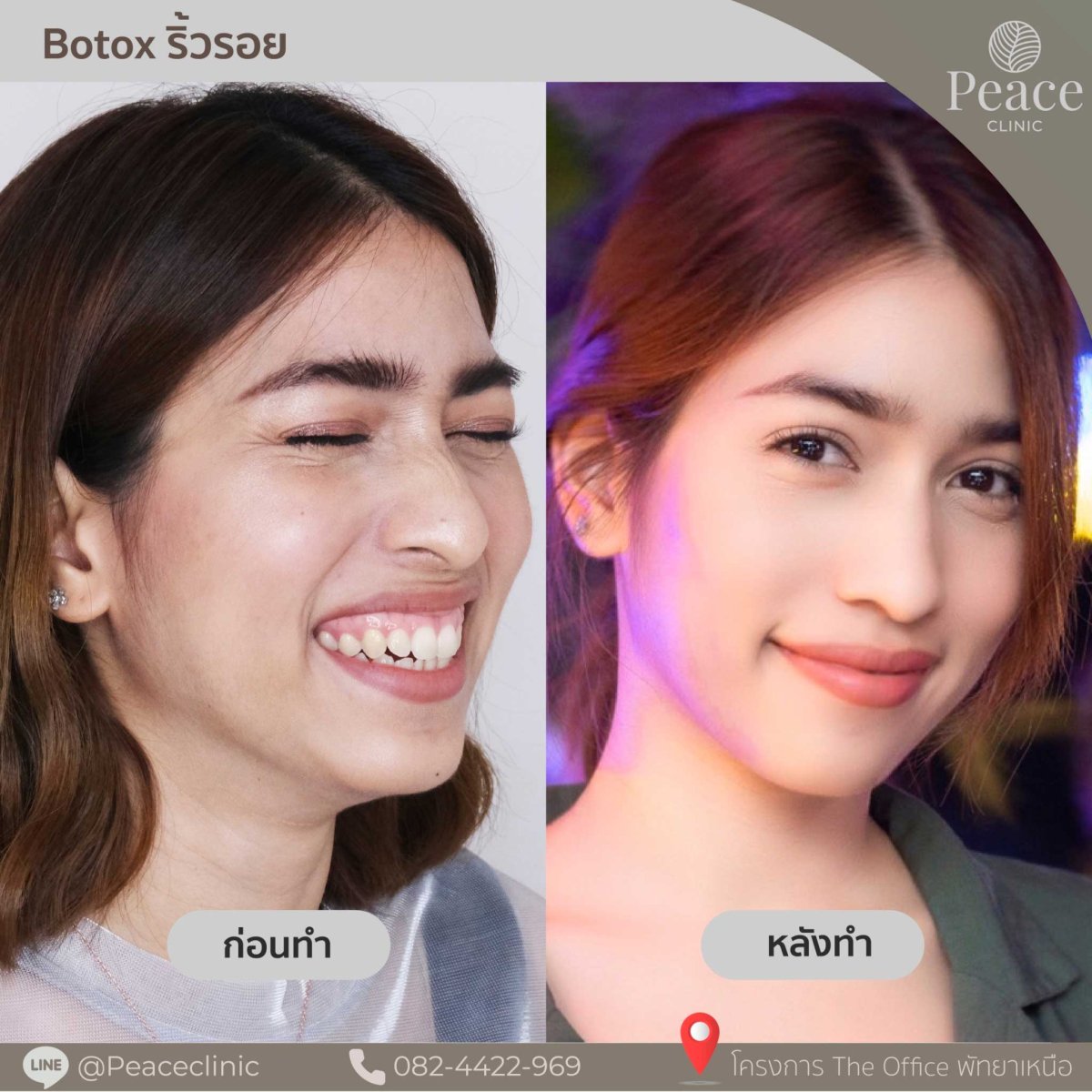 Before and after Botox wrinkle treatment results at Peace Clinic, smoother facial skin