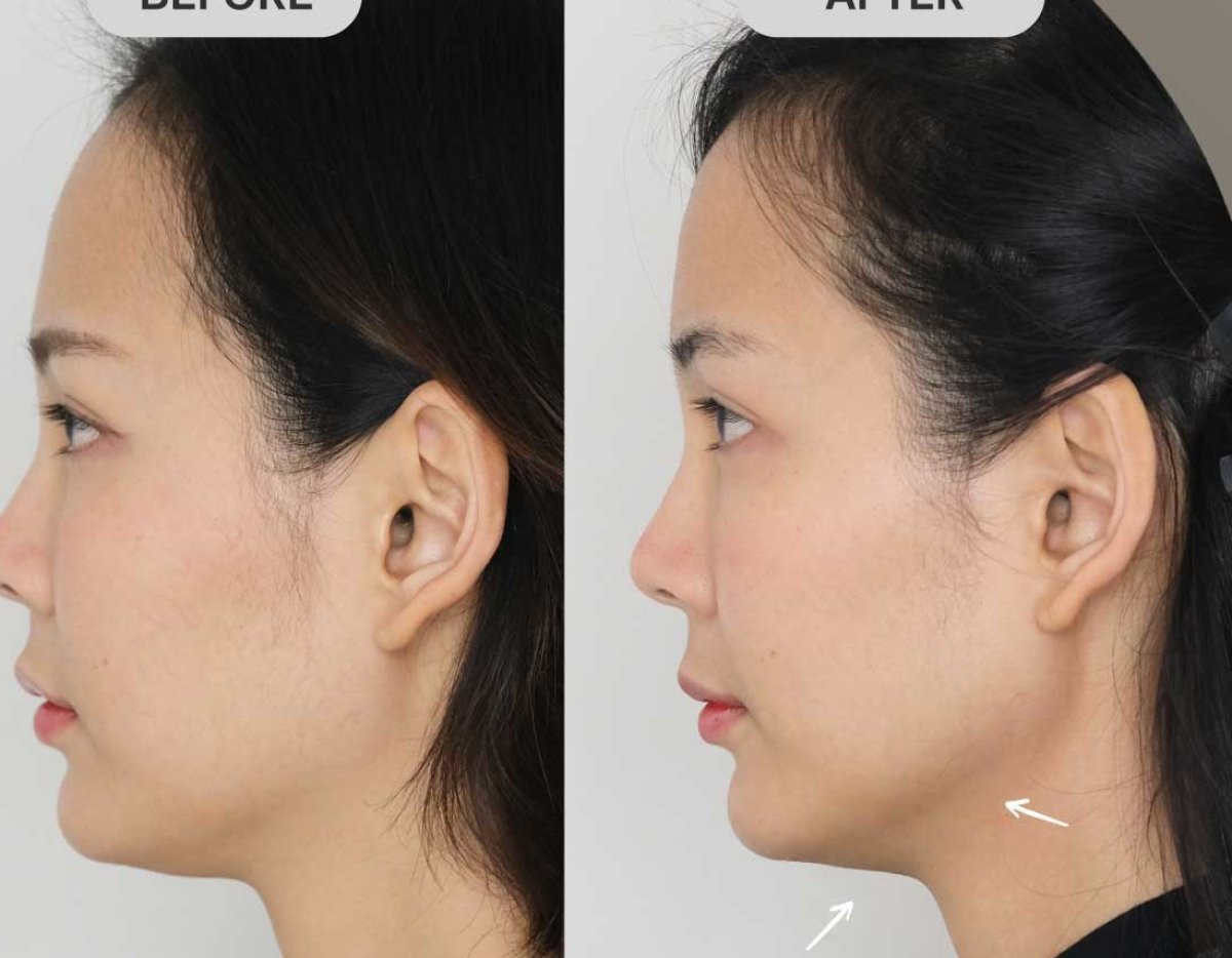نتائج قبل وبعد علاج Ultherapy – تحسن واضح في خط الفك والرقبة