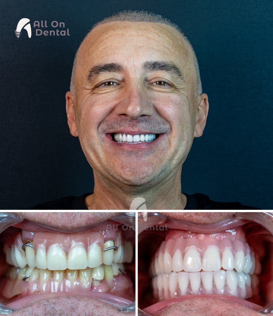 Результати до та після імплантації All-on-4 в All On Dental Istanbul, відновлення посмішки