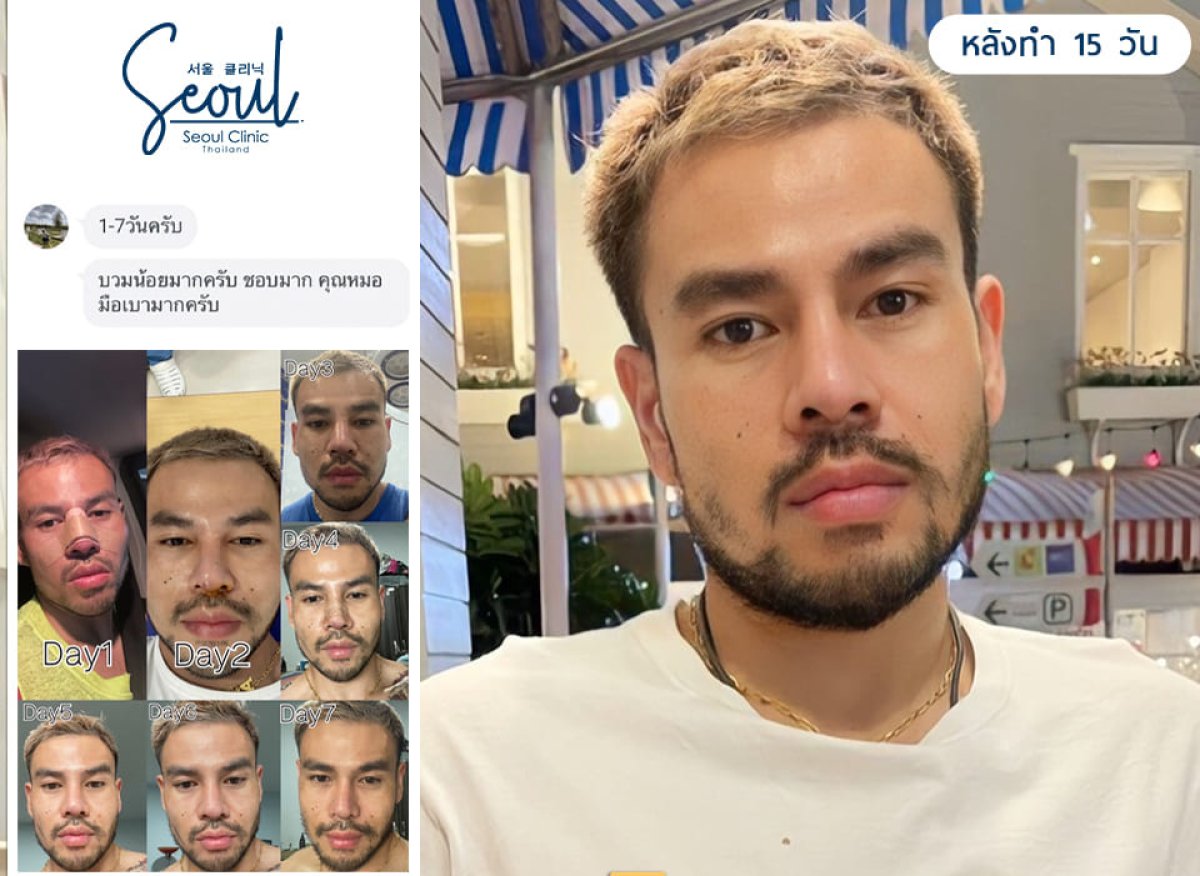 نتائج تجميل الأنف قبل وبعد في عيادة سيول، تطور شكل الأنف خلال 15 يومًا