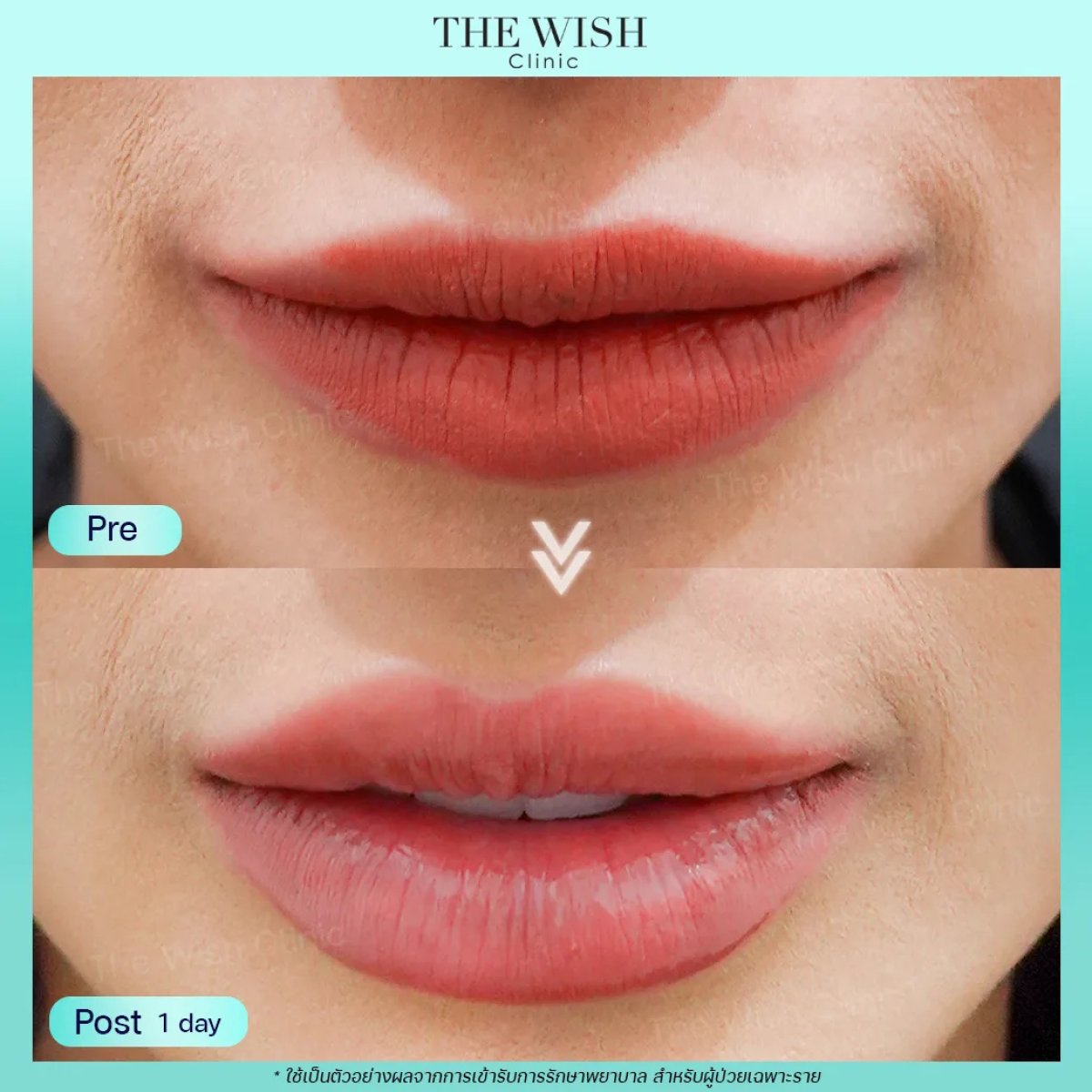 Before and after hyaluronic acid lip fillers result at The Wish Clinic – fuller lips