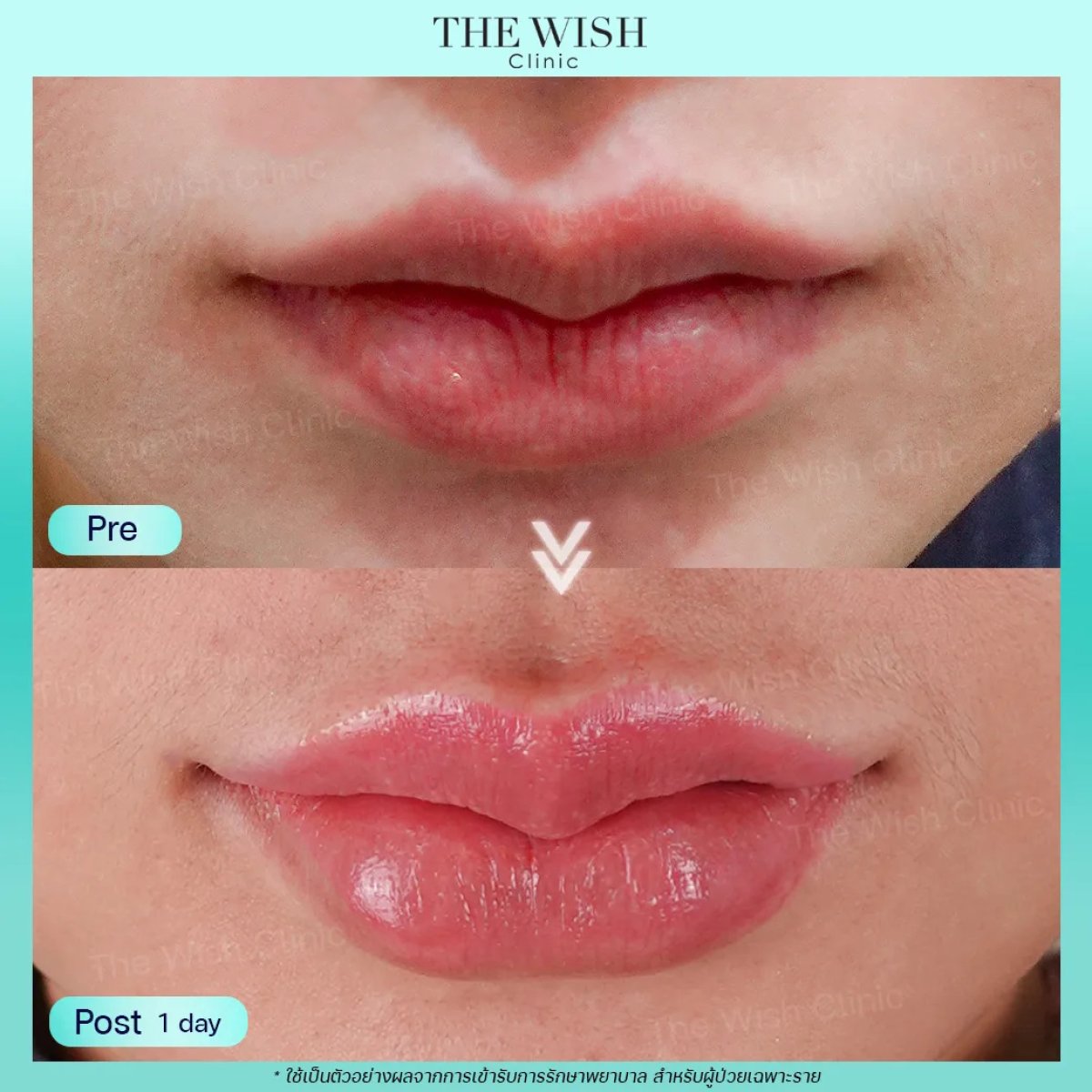 نتيجة قبل وبعد فيلر الشفاه بحمض الهيالورونيك في The Wish Clinic – شفاه ممتلئة