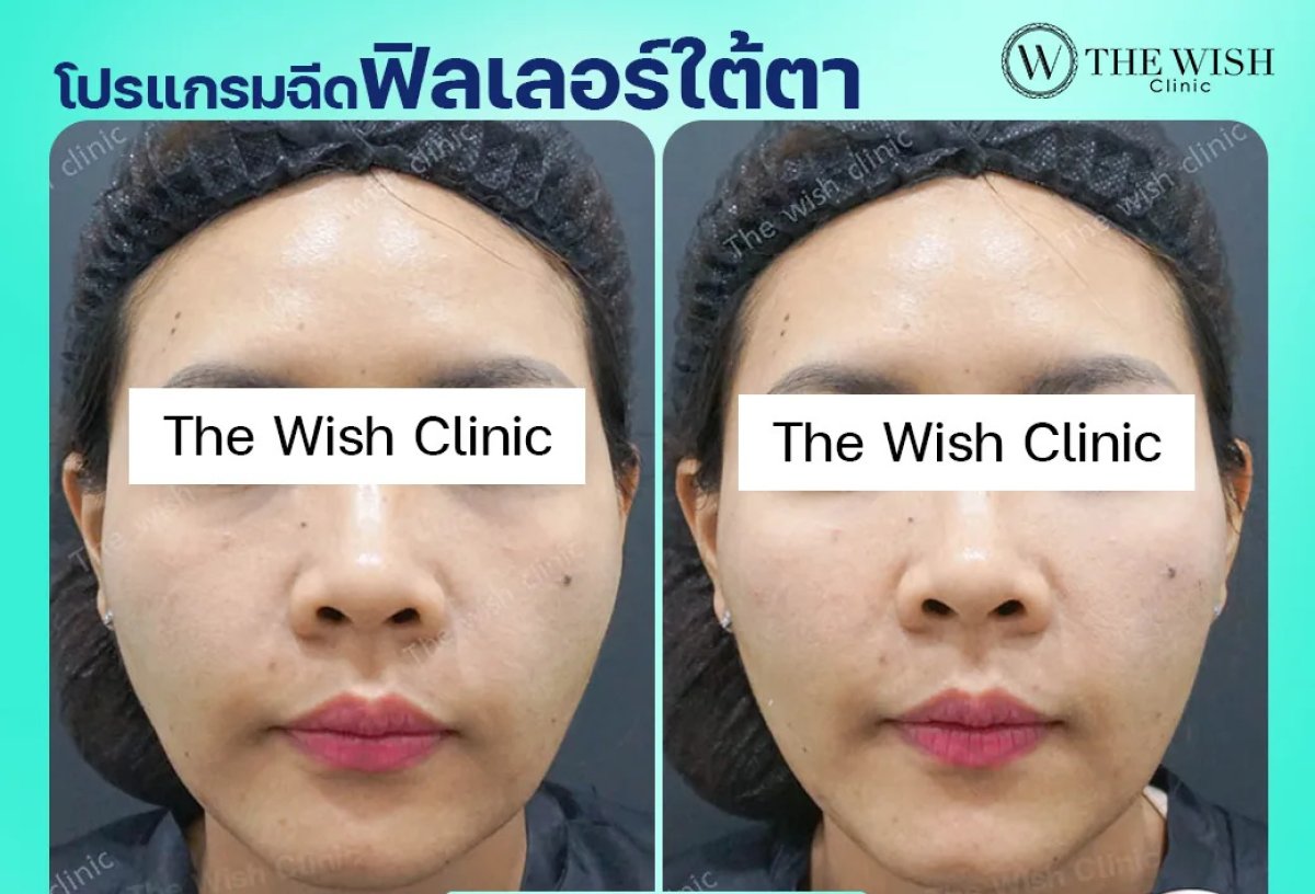 نتائج قبل وبعد فيلر حمض الهيالورونيك تحت العين في The Wish Clinic، تجديد ملحوظ