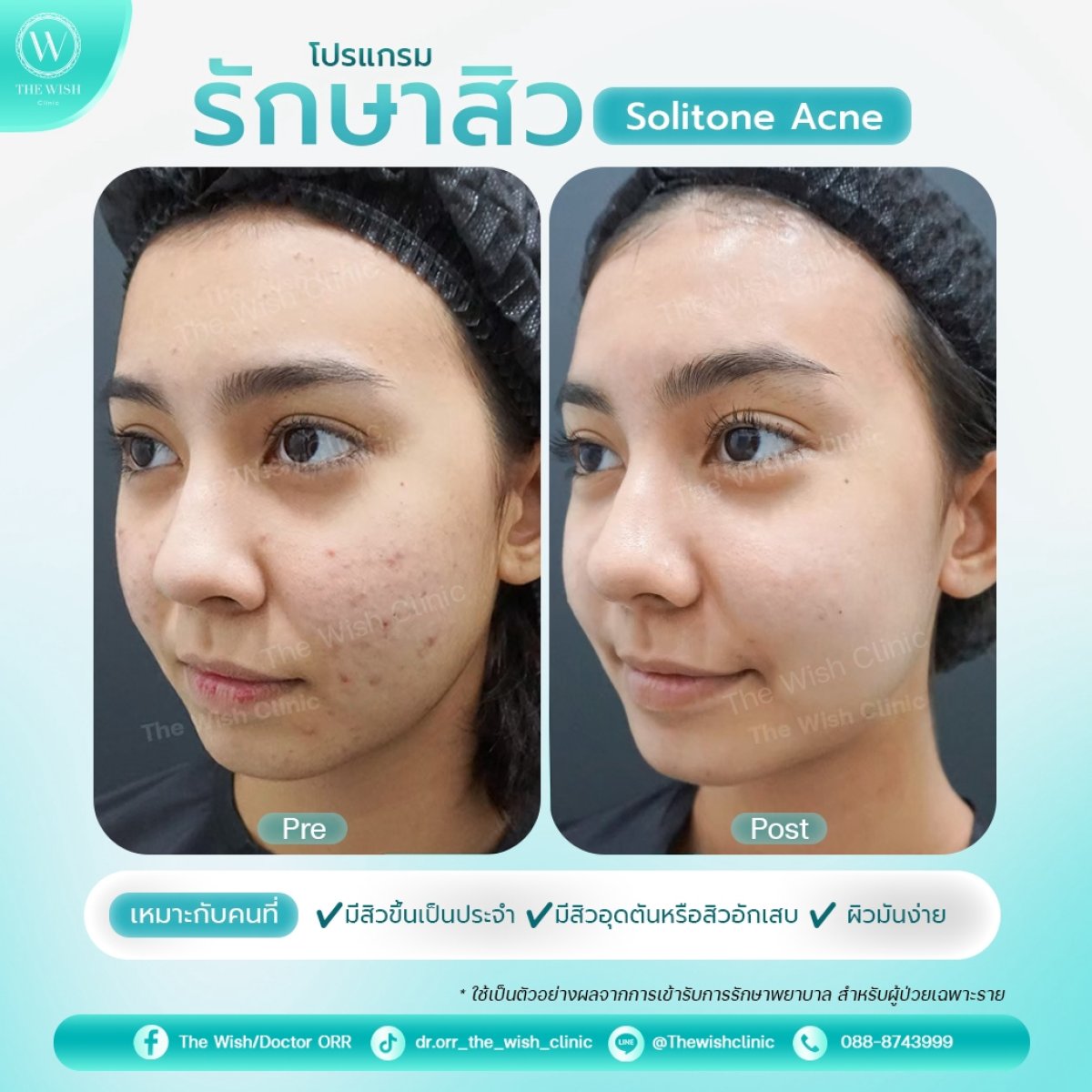 Vorher-nachher-Ergebnisse der Aknenarbenbehandlung in The Wish Clinic mit Solitone Acne