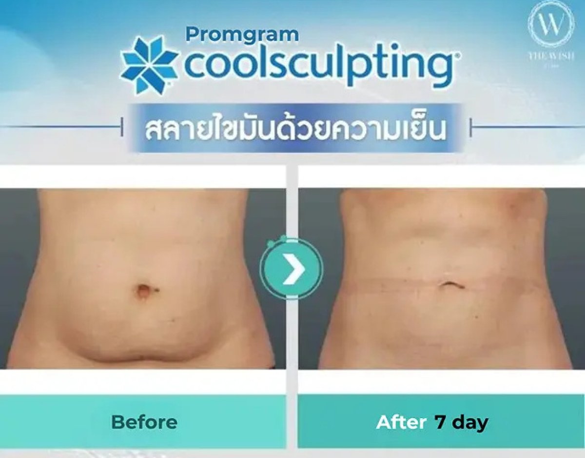 Before and after Coolsculpting results – visible abdominal fat reduction after 7 days