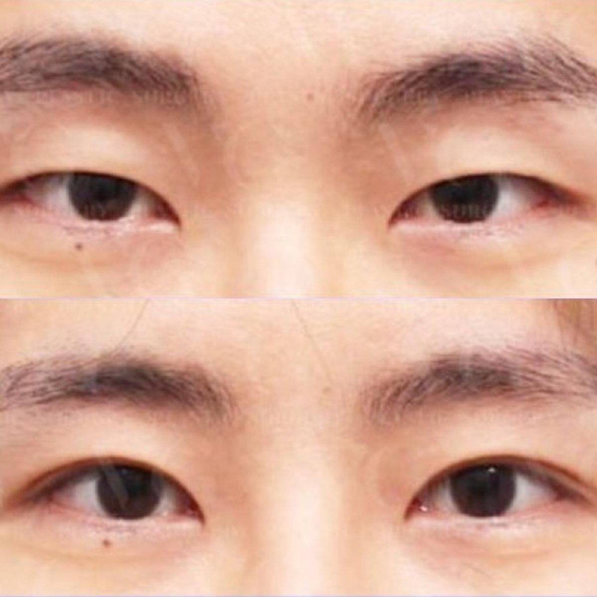 Resultados de blefaroplastia antes y después en VG Plastic Surgery, corrección de párpados
