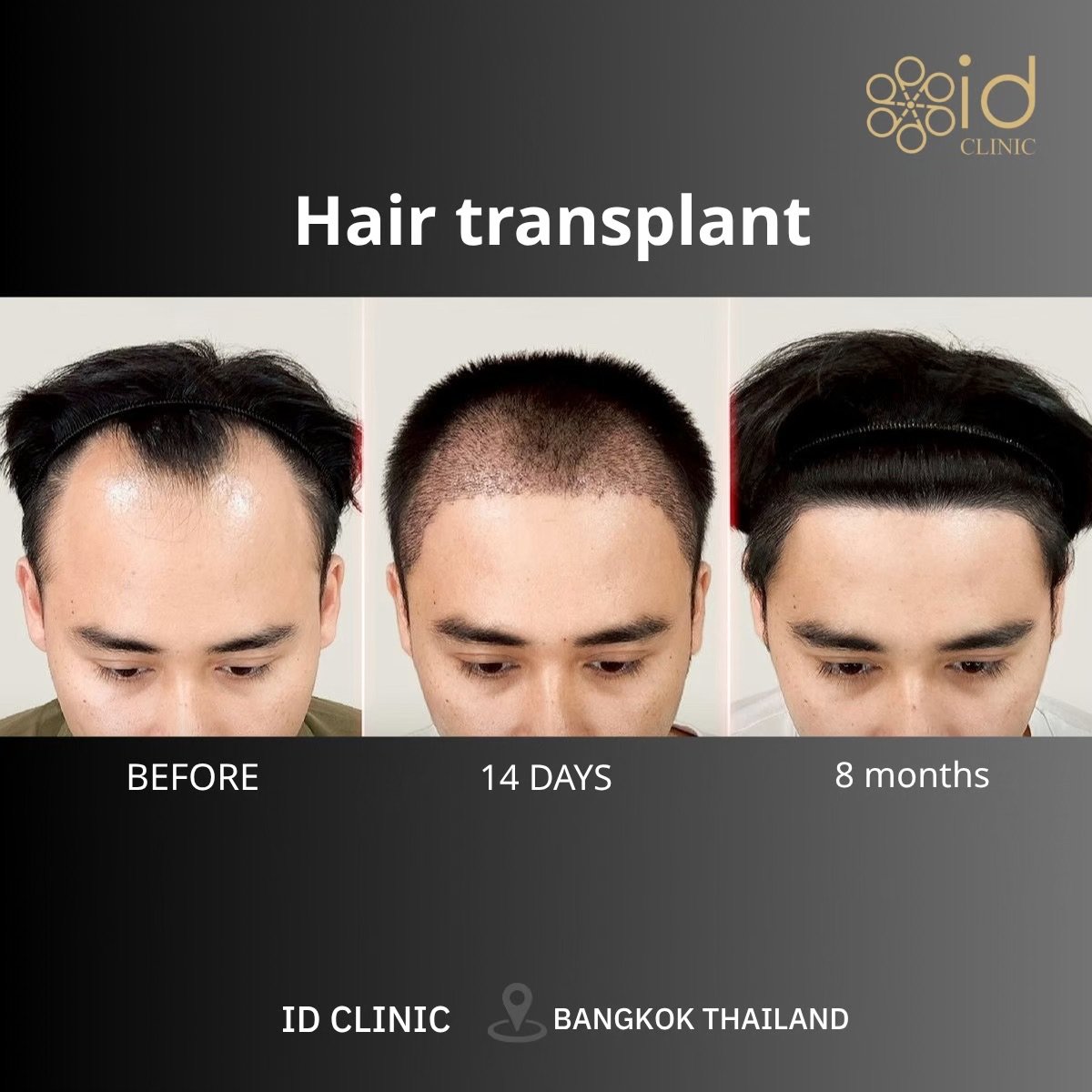 DHI hair transplant before and after results at ID Clinic Bangkok, visible hairline restoration