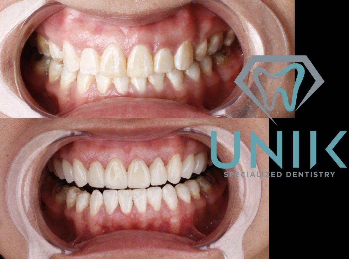 نتيجة قبل وبعد الفينير في UNIIK Specialized Dentistry – تحول الابتسامة