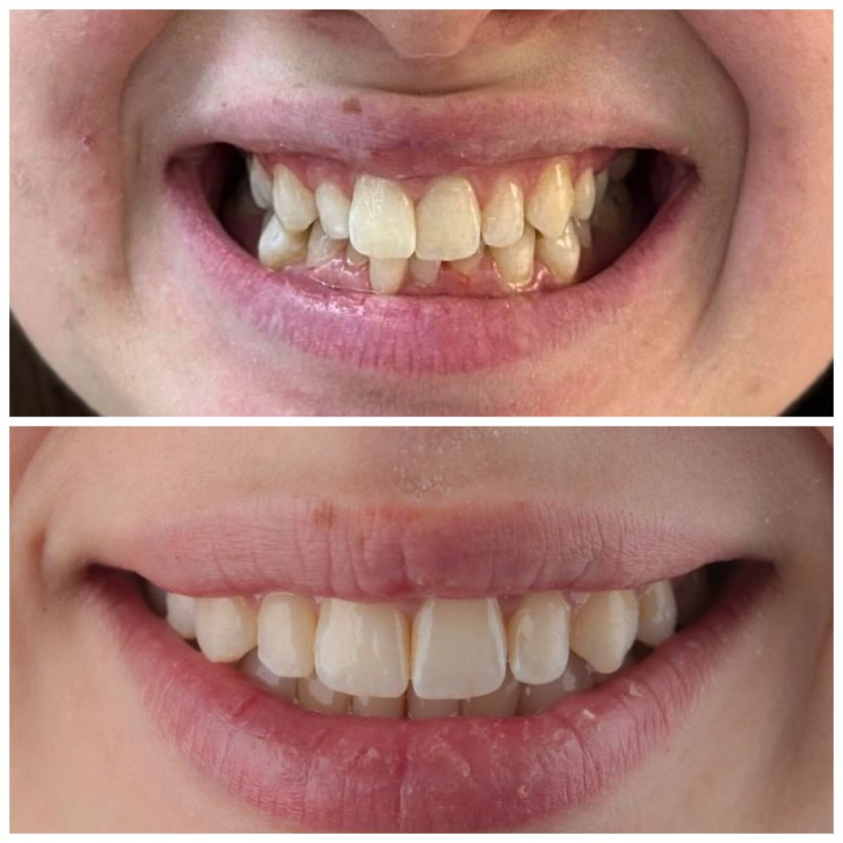 Результати до і після Invisalign у SUAVE DENTAL CLINIC, вирівнювання зубів