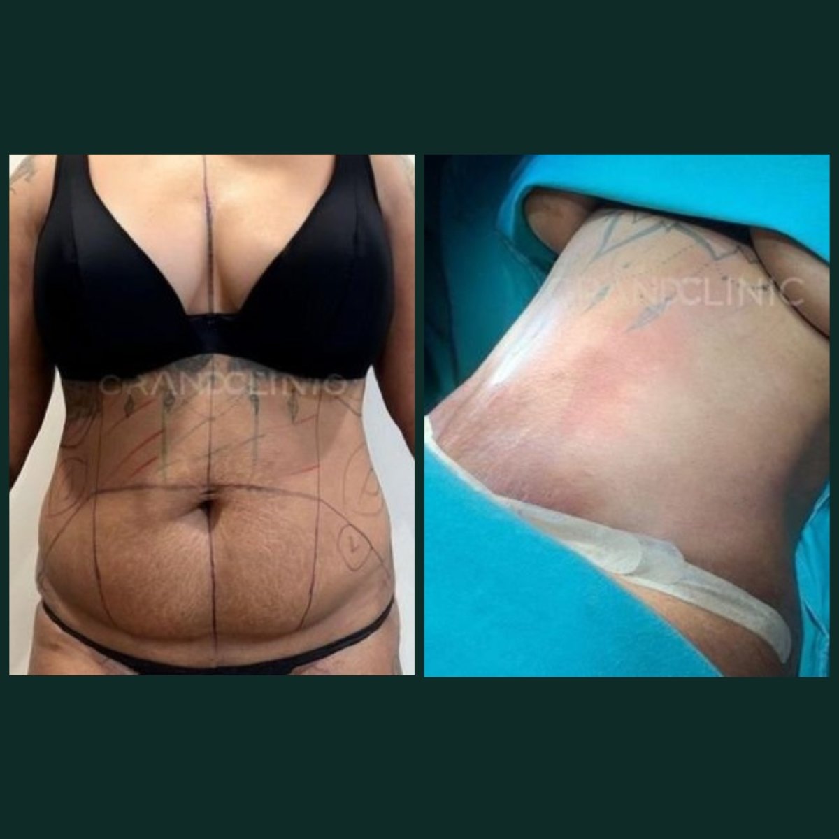 نتائج شفط الدهون فايزر قبل وبعد في Grand Clinic – تحسين واضح لمنطقة البطن