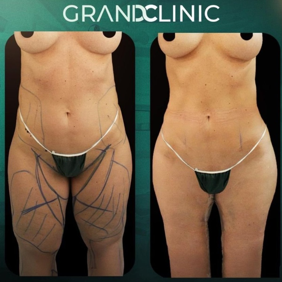 Before and after Vaser liposuction results at Grand Clinic, body contouring improvement