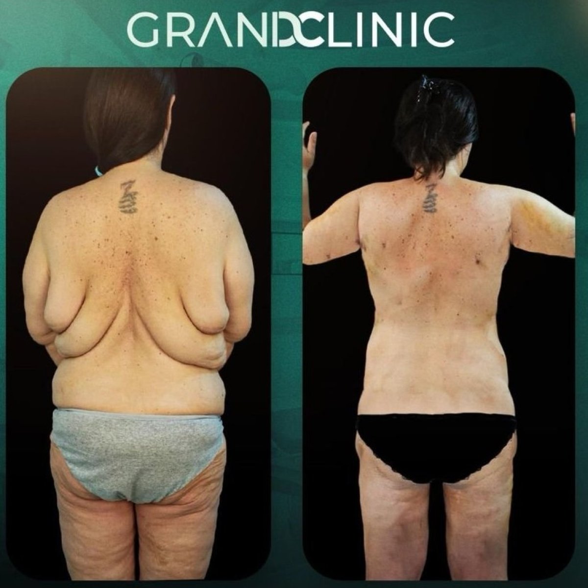 Before and after full body lift at Grand Clinic, visible back contour improvement result