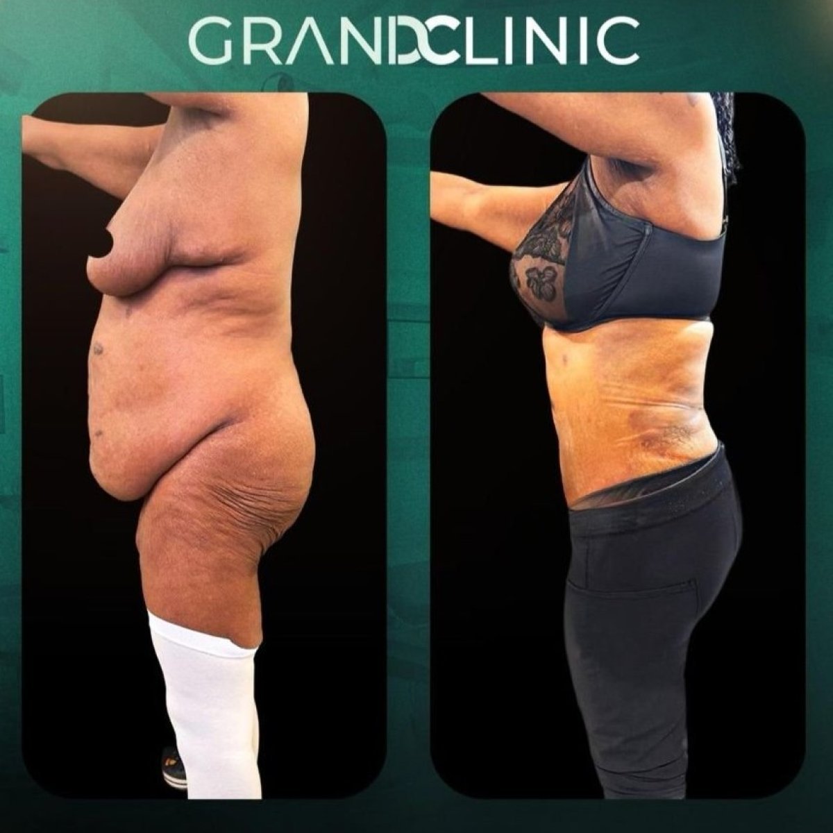 Before and after full body lift results at Grand Clinic – visible body contour improvement