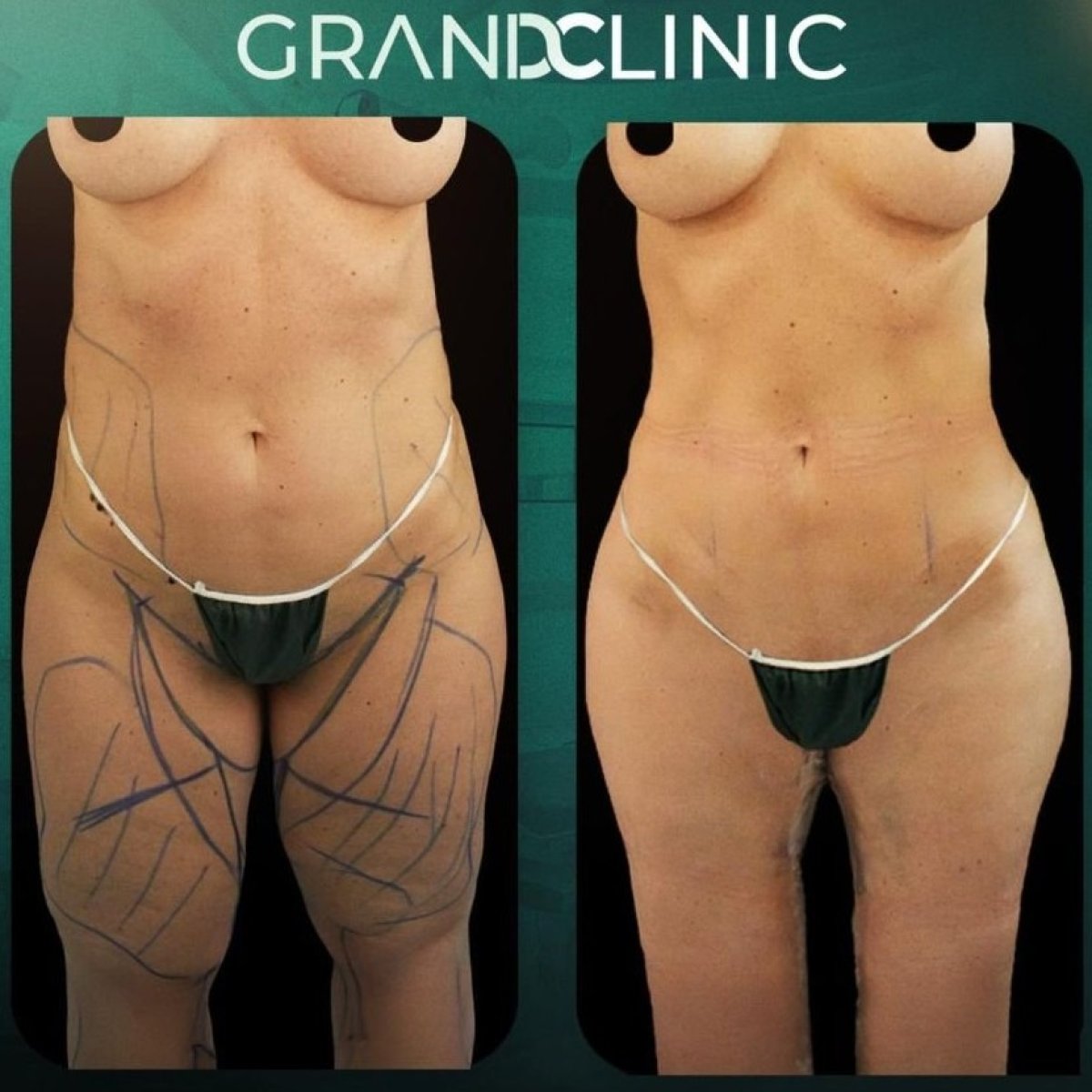 نتائج شفط الدهون قبل وبعد في Grand Clinic، تحسين واضح لتنسيق الجسم