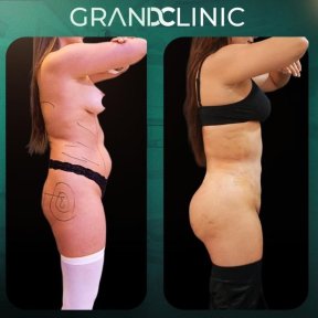 Premium Liposuction All Included - photo 4