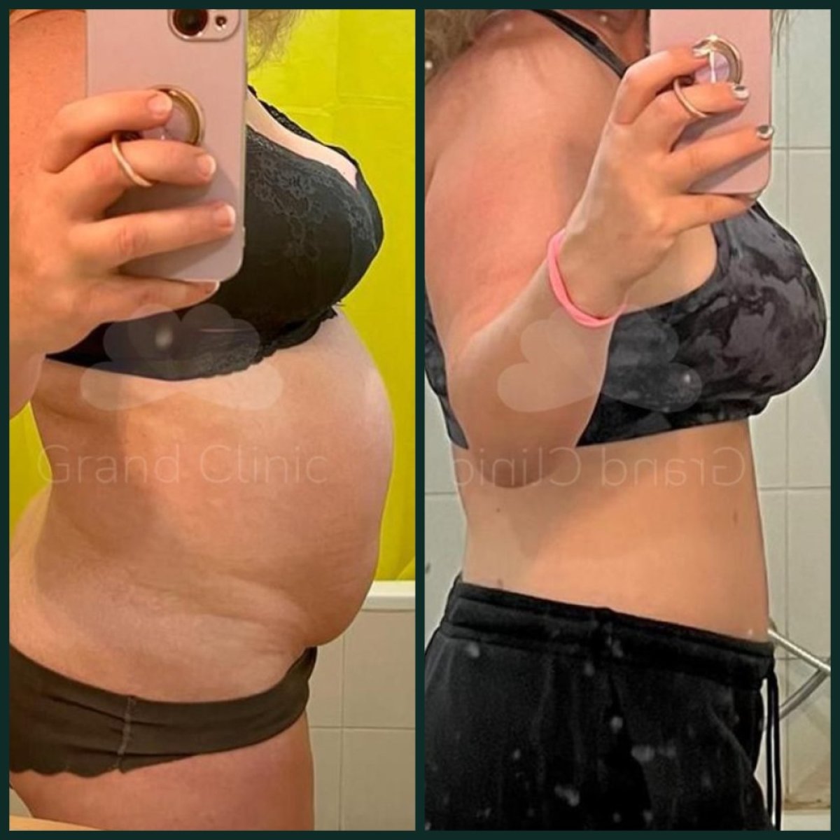 Before and after 360 liposuction result at Grand Clinic – visible abdominal contour improvement