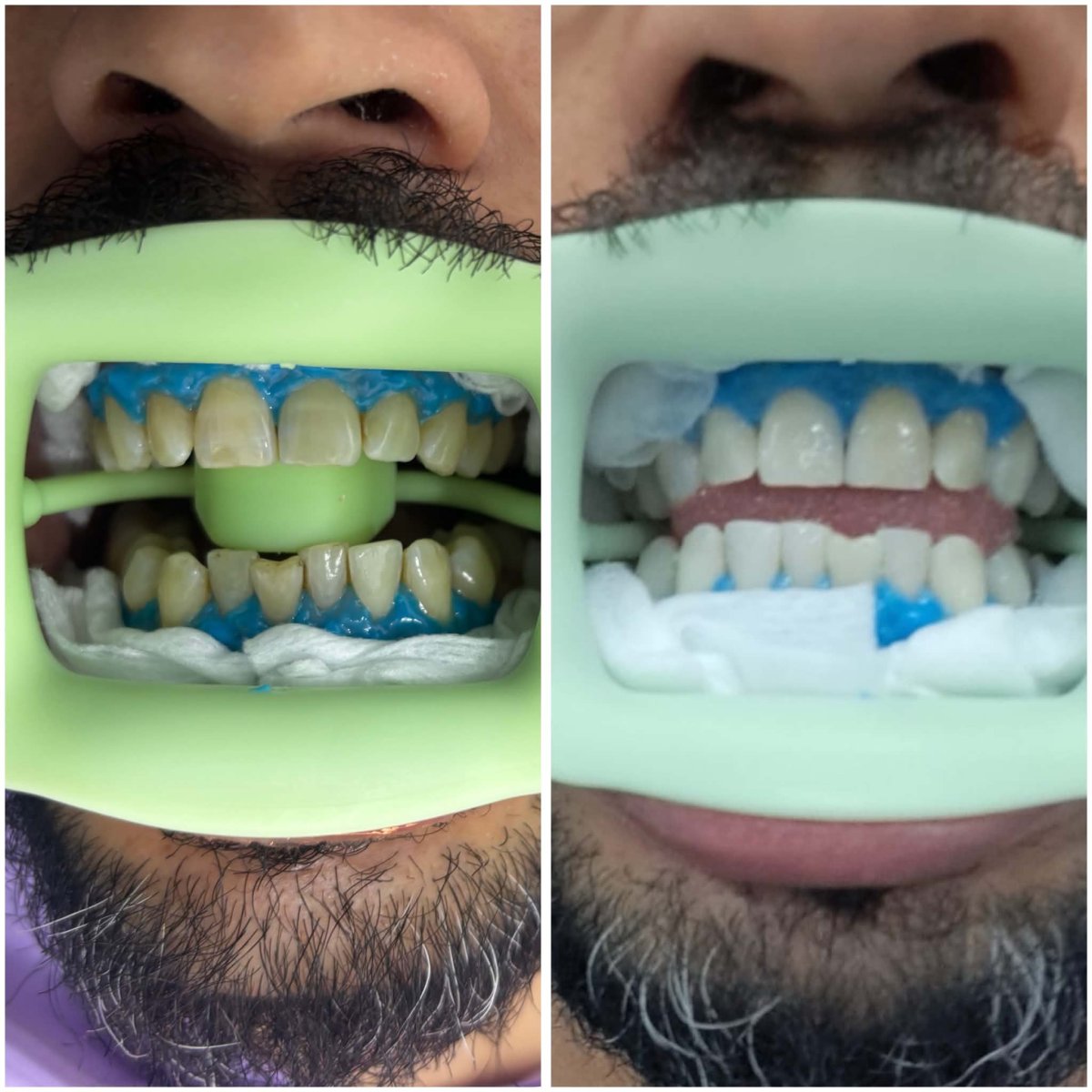 Resultados de blanqueamiento dental antes y después: sonrisa visiblemente más blanca