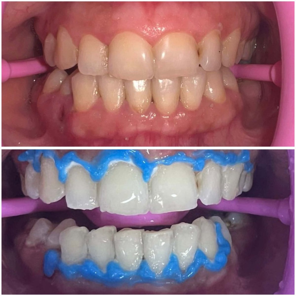 Resultados de blanqueamiento dental antes y después, mejora visible en color y brillo