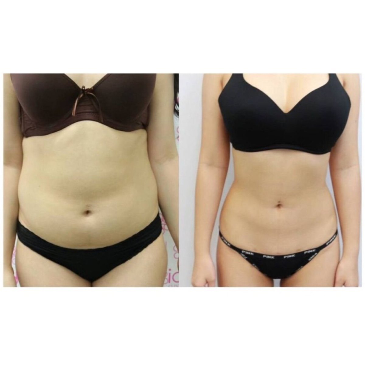 Résultats avant et après liposuccion à la clinique Somchai, amélioration visible de la silhouette