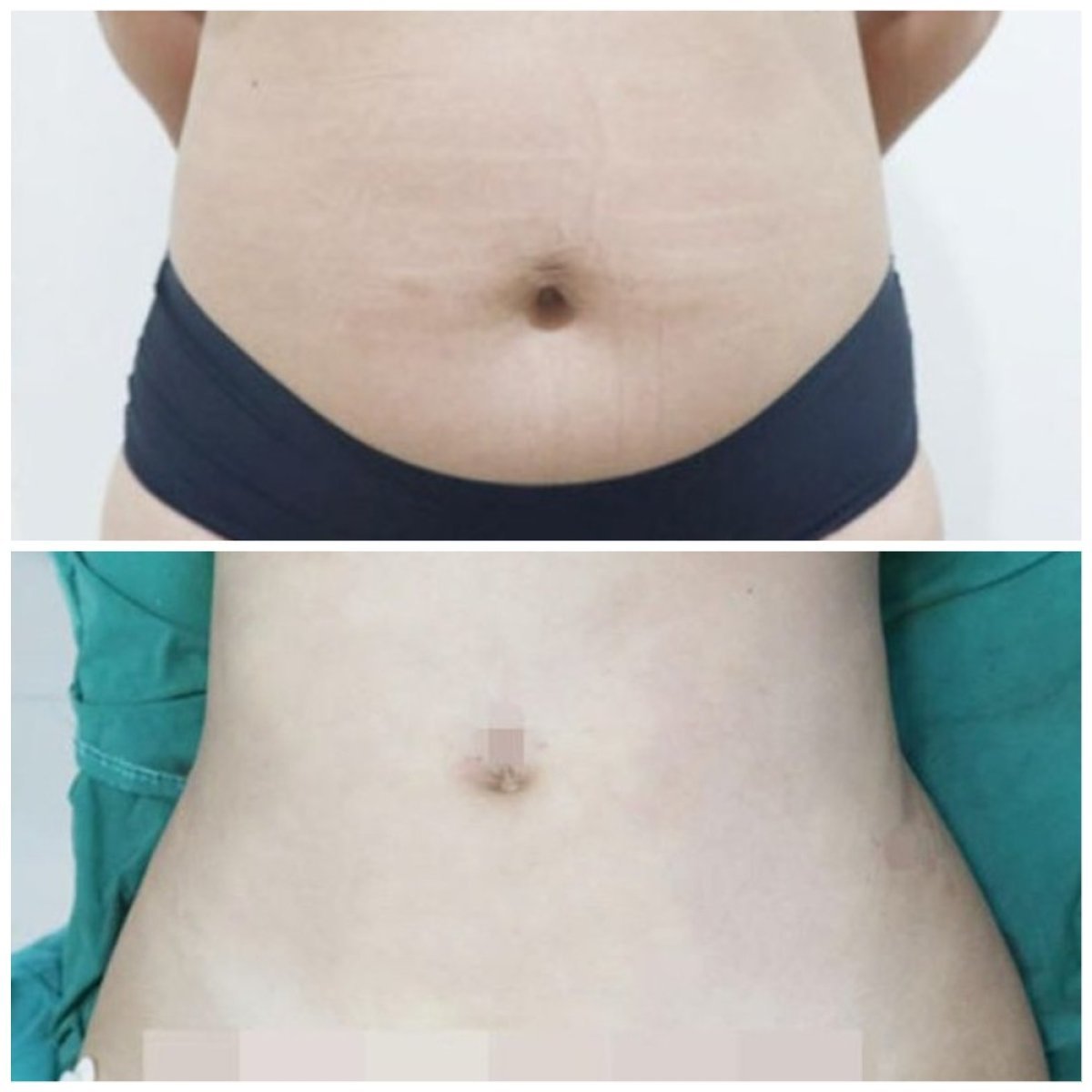 نتائج شفط الدهون 360 قبل وبعد في عيادة سومشاي، تحسين واضح لمحيط الخصر