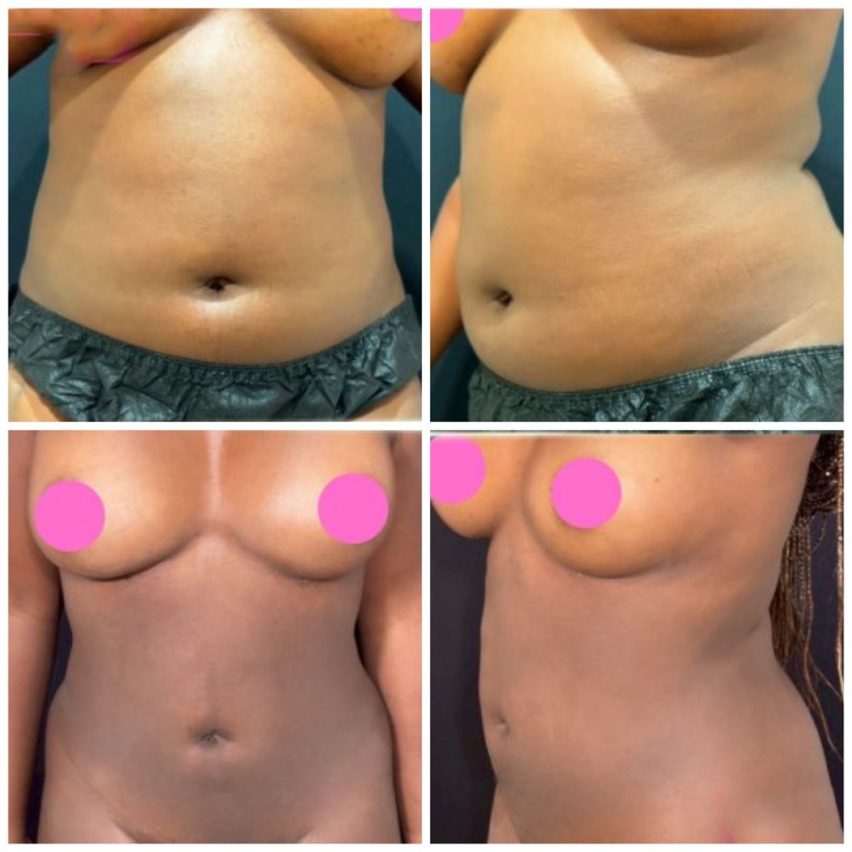 Résultats avant/après liposuccion 360 à la clinique Somchai, amélioration visible de la silhouette