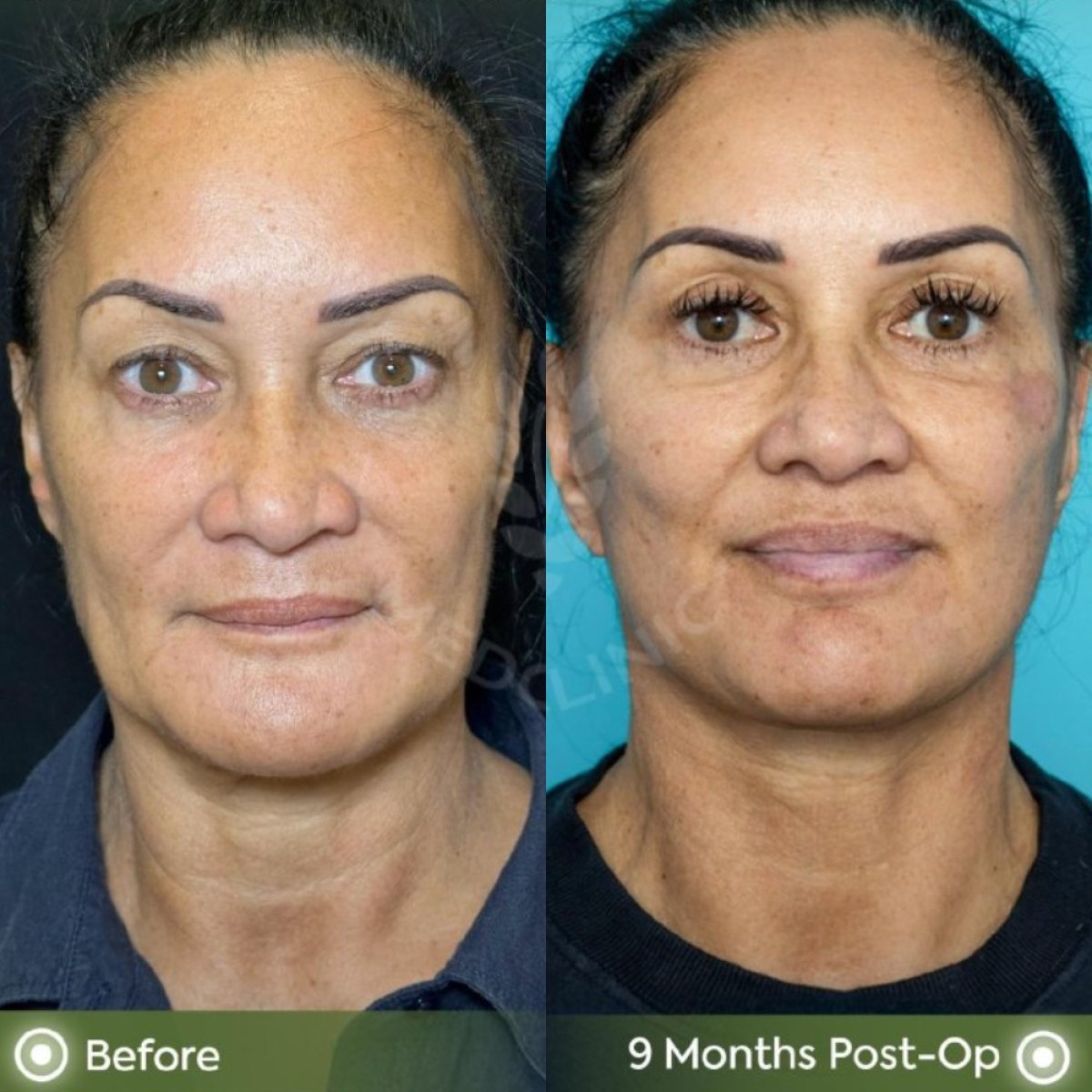Efekty deep plane facelift przed i po w Dr. Safa Manav Clinic, 9 miesięcy po zabiegu