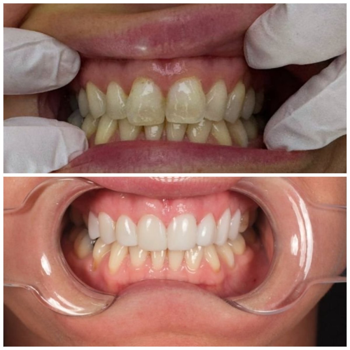 Résultats avant et après bonding dentaire chez Inter Dental Turkey – sourire amélioré