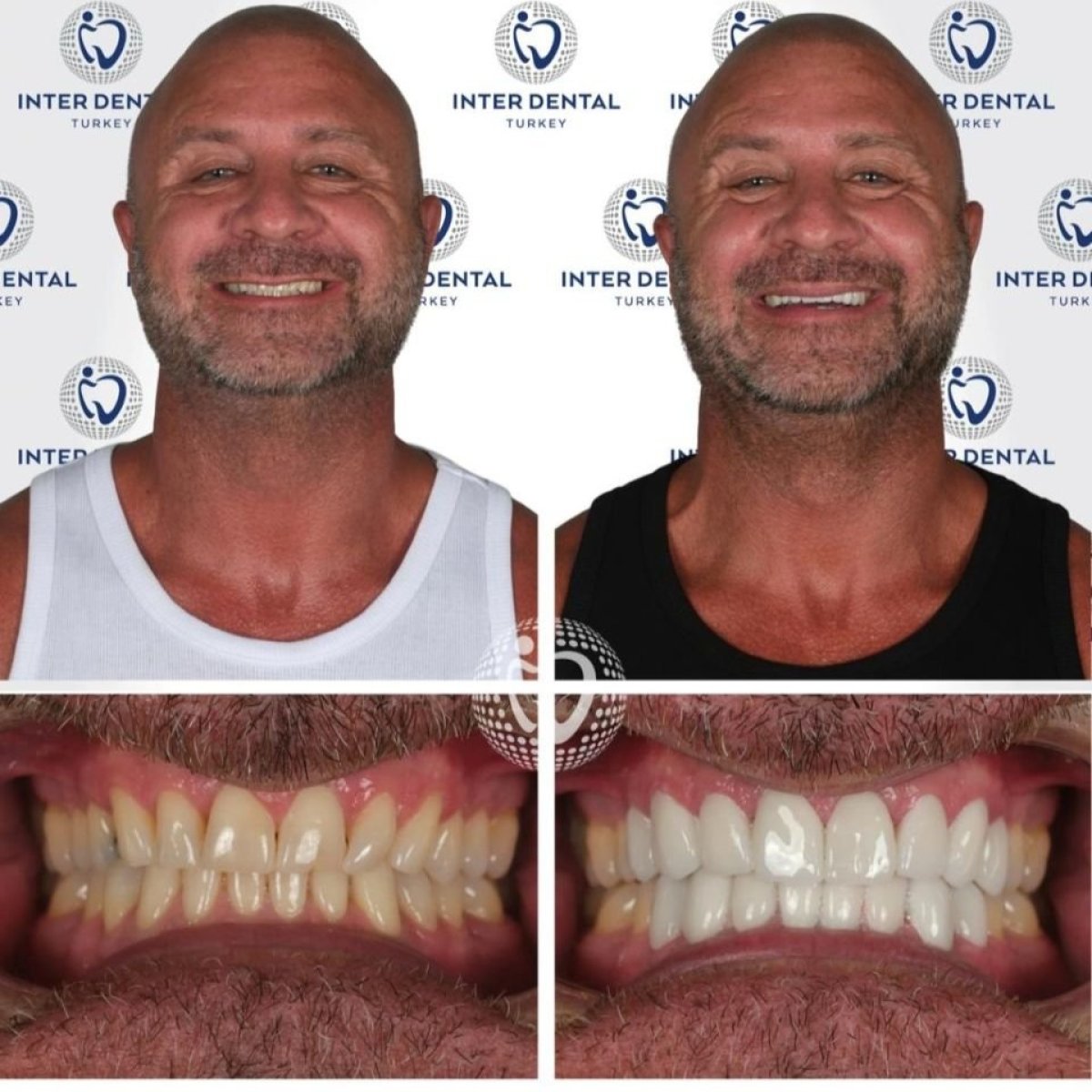 Before and after Emax veneers result at Inter Dental Turkey – whiter, even smile transformation