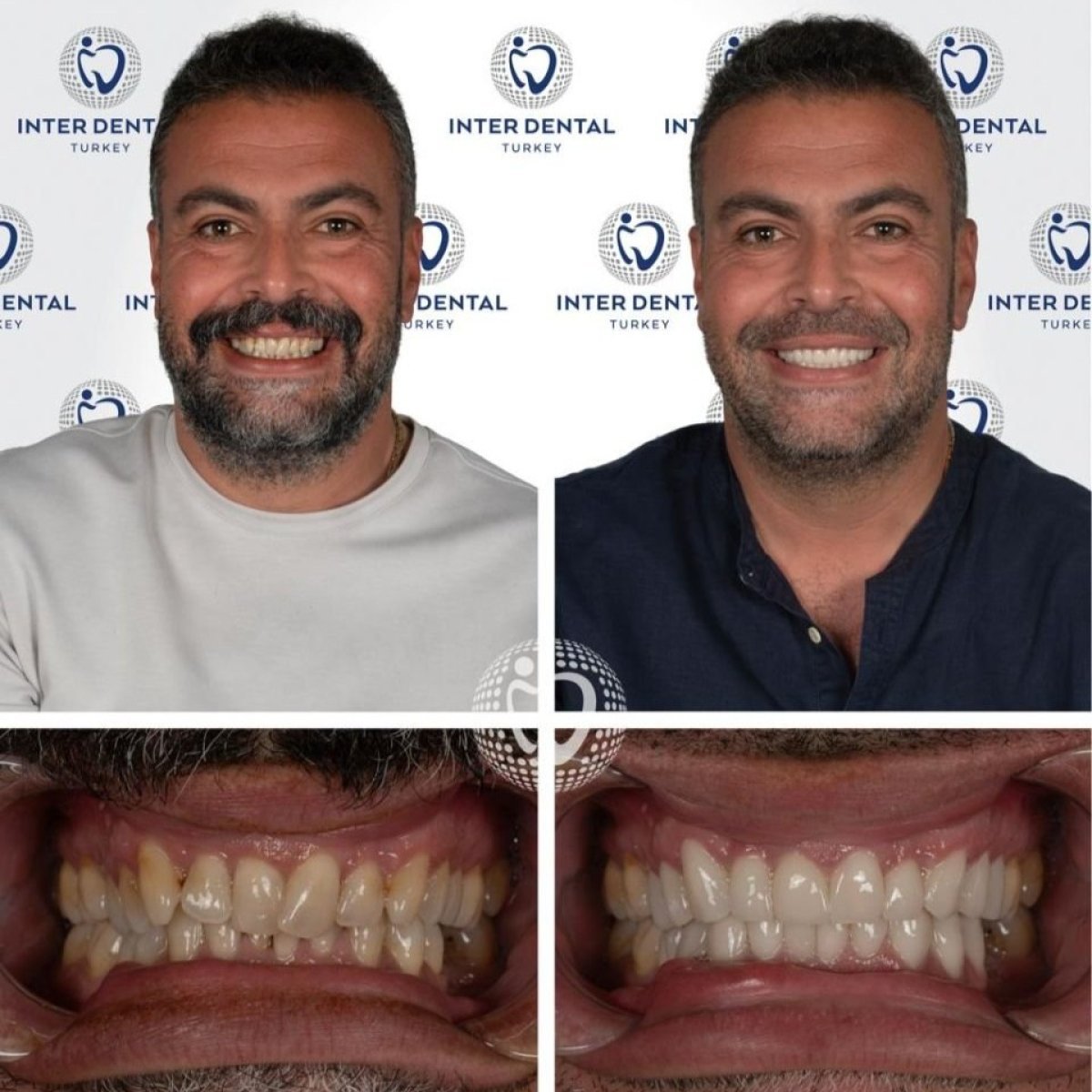 نتائج قبل وبعد فينير إيماكس في Inter Dental Turkey – ابتسامة أكثر بياضًا